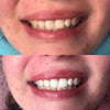 Experimente las fotos de antes y después del gel blanqueador dental PAP+ de Diamond Smile