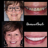 Mujer mayor Fotos de antes y después del gel blanqueador dental PAP+ de Diamond Smile